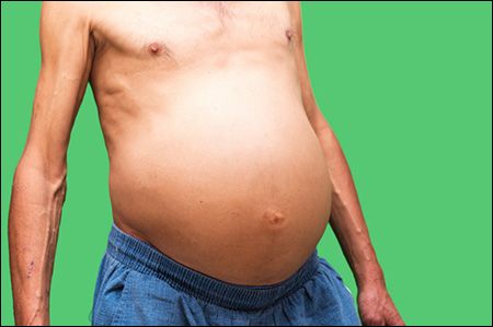 Patient with tense ascites