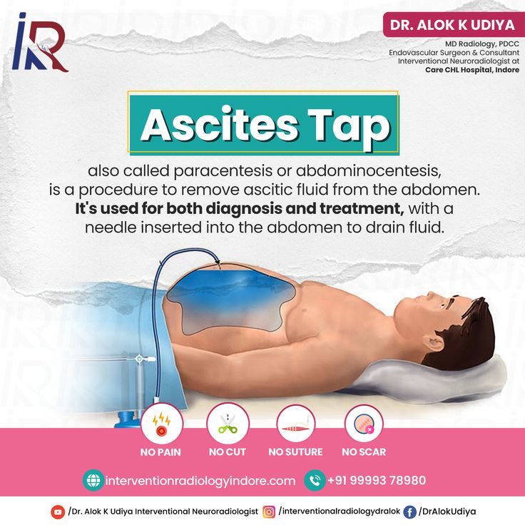 Paracentesis and TIPS illustration