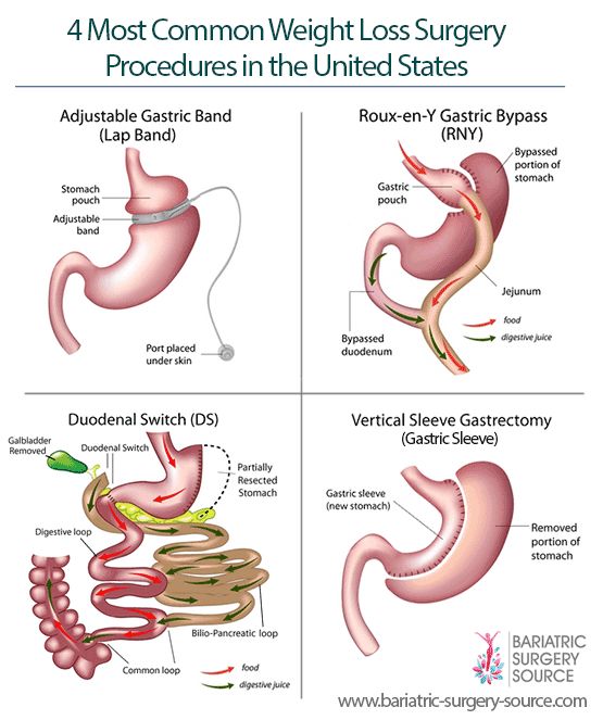 Gastric bypass surgery in liver transplant patient