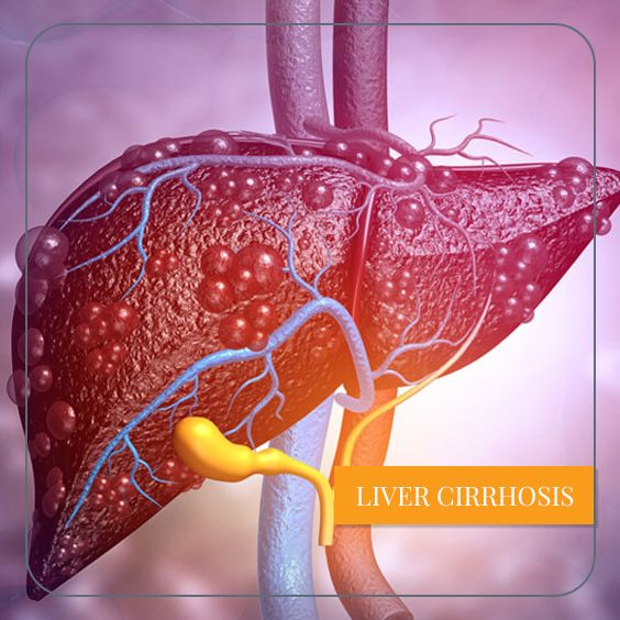 Cirrhotic liver image