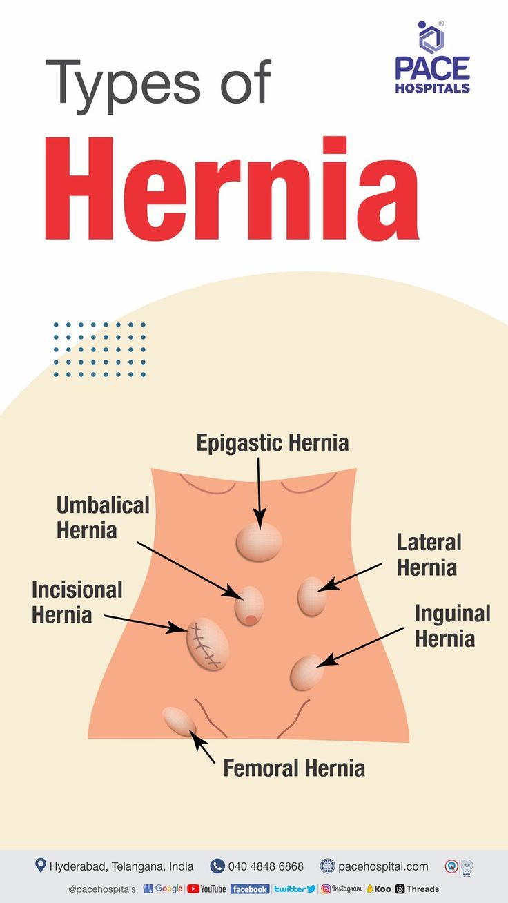 Hernia image (LiverTransplantGuide hernia1)