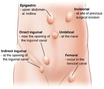 Hernia image (LiverTransplantGuide hernia2)