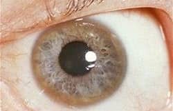 Kayser–Fleischer ring showing copper deposition at the corneal edge in Wilson disease